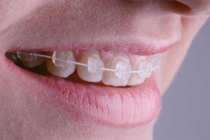 ceramic_braces2 braces at avant dental clinic kolkata