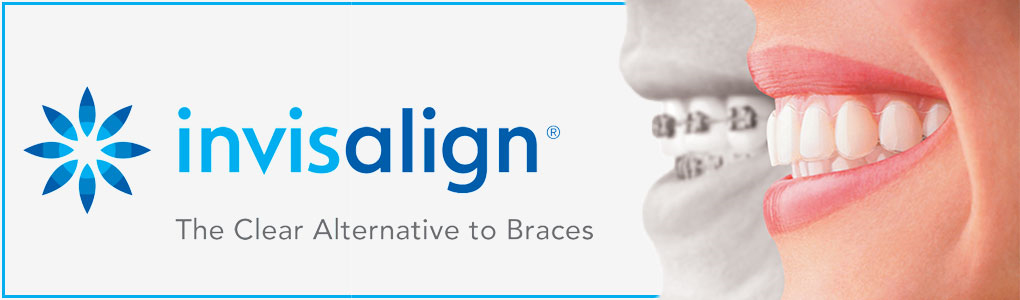invisalign1 clear brace at avant dental clinic kolkata
