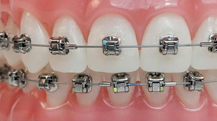braces at avant dental clinic kolkata