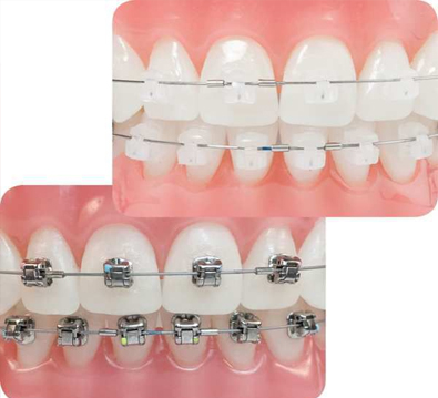 braces at avant dental clinic kolkata