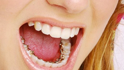 lingual_braces1 brace at avant dental clinic kolkata