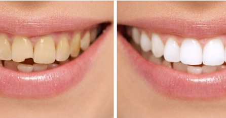 make before and after treatment at avant dental clinic kolkata