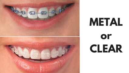 metal_braces1 braces at avant dental clinic kolkata