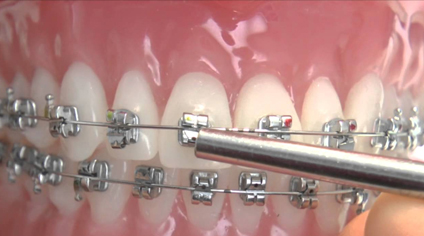 braces at avant dental clinic kolkata