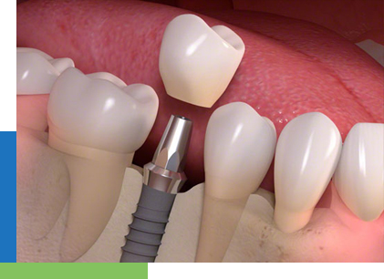 tooth_im denture supporter at avant dental clinic kolkata