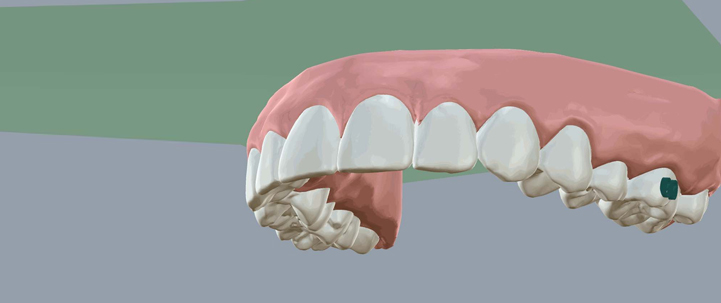 3d human teeth at avant dental clinic kolkata