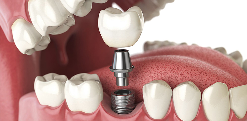teeth implant at avant dental clinic kolkata