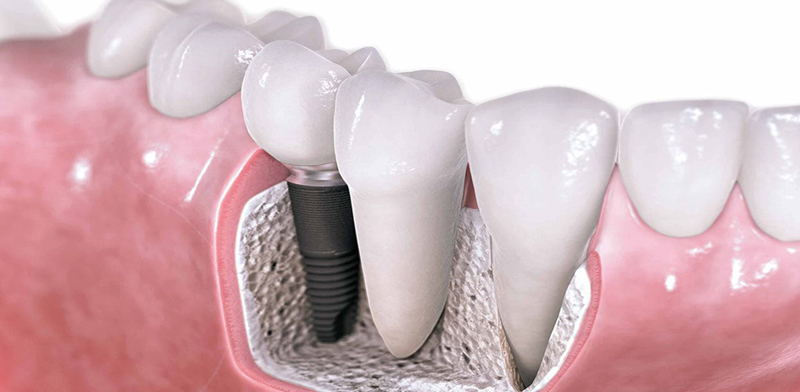 new dental implants at avant dental clinic kolkata