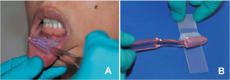 oral-biopsy-avant-dental