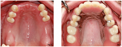 denture implant treatment at avant dental clinic kolkata