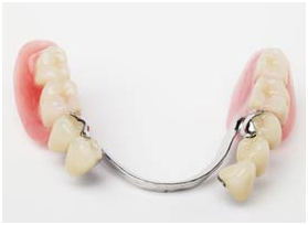 denture implant at avant dental clinic kolkata