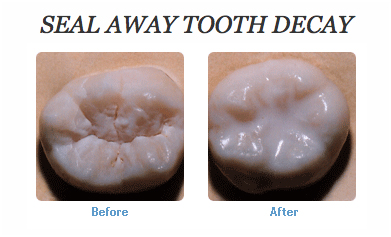 dental sealant at avant dental clinic kolkata