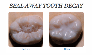 Untitled-3 dental sealant at avant dental clinic kolkata