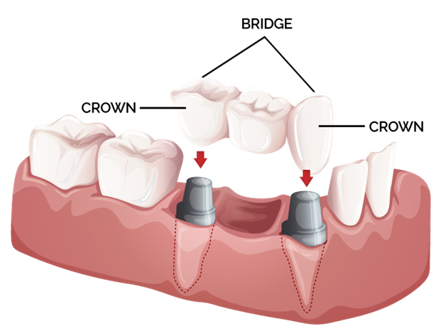 teeth crown implant treatment at avant dental clinic kolkata