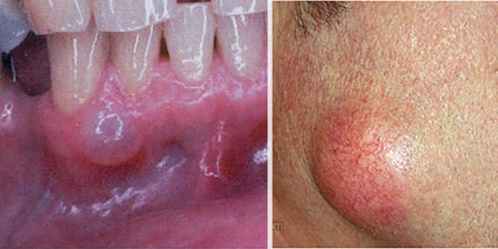 Untitled-6 tumor treatment at avant dental clinic kolkata