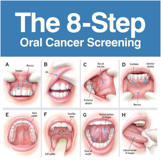 oral cancer screening at avant dental clinic kolkata