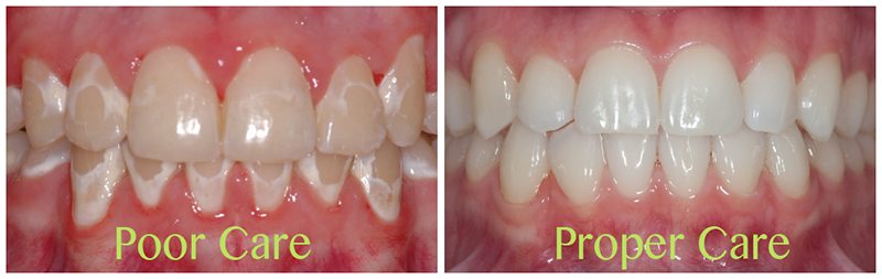 fluoride treatment at avant dental clinic kolkata