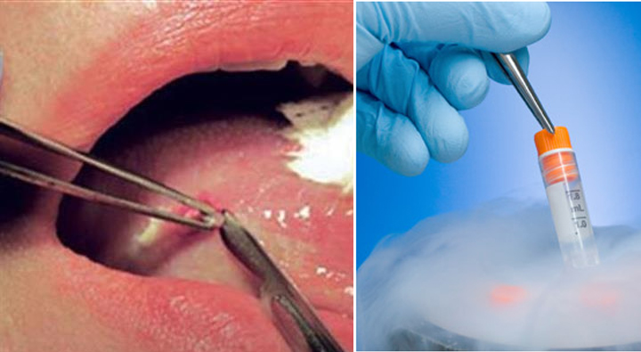 oral biopsy at avant dental clinic kolkata