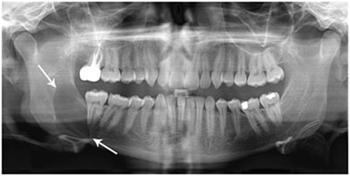 Jaw Tumor Cyst Removal Avant Dental