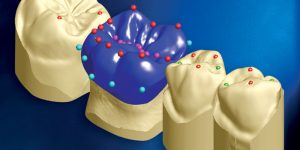 CAD CAM Crowns - Avant Dental