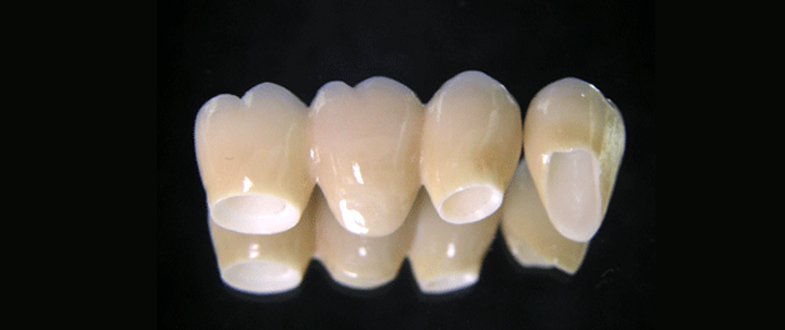 cad-cam cad cam technology at avant dental clinic kolkata