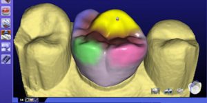 CAD CAM Crowns - Avant Dental