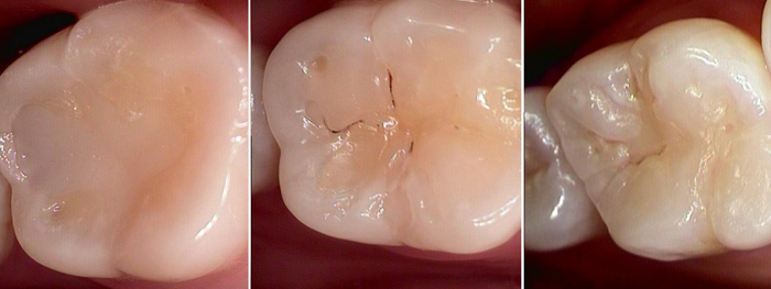 camera before and after treatment at avant dental clinic kolkata