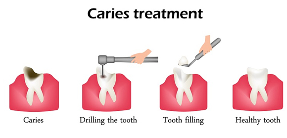 tooth filling at avant dental clinic kolkata