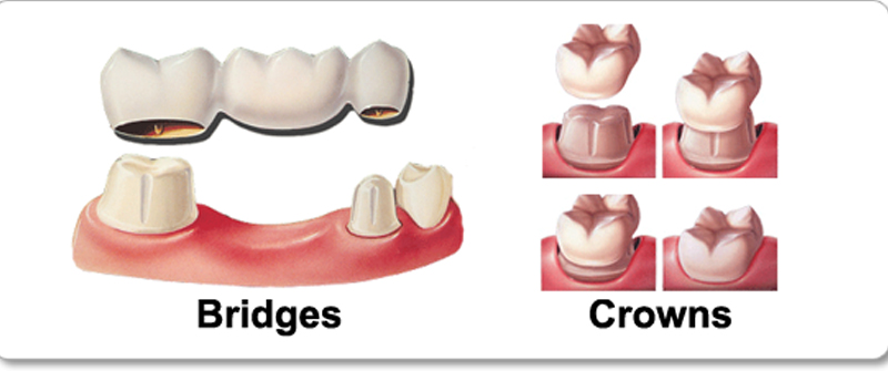 bridges and crown at avant dental clinic kolkata