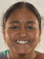 child_1 before treatment at avant dental clinic kolkata