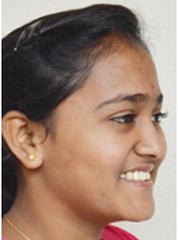 child_2_2 after teeth treatment at avant dental clinic kolkata