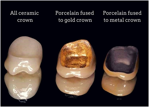teeth crown at avant dental clinic kolkata