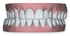 cross invisible brace at avant dental clinic kolkata