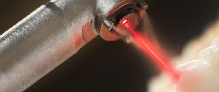 lasers treatment at avant dental clinic kolkata