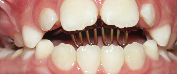 teeth treatment at avant dental clinic kolkata