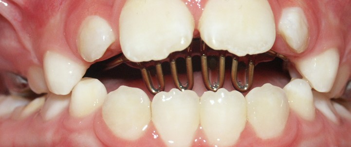habbit-breaking teeth treatment at avant dental clinic kolkata