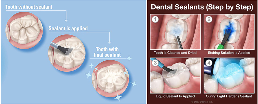 dental sealants at avant dental clinic kolkata