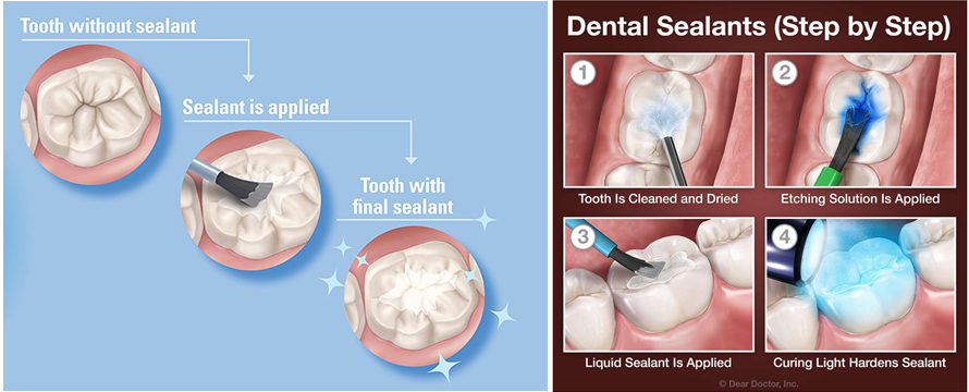 imag dental sealants at avant dental clinic kolkata