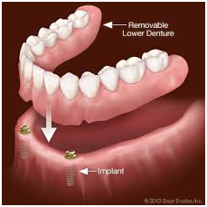 implant supporter at avant dental clinic kolkata