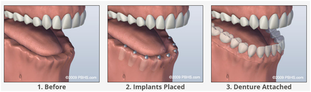 implant supporter denture at avant dental clinic kolkata