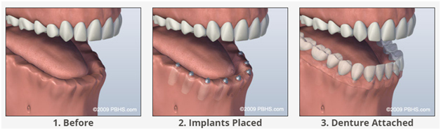 impl implant supporter denture at avant dental clinic kolkata
