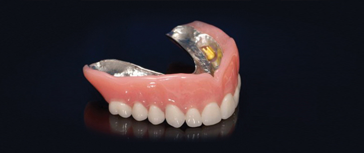 implant teeth structure at avant dental clinic kolkata