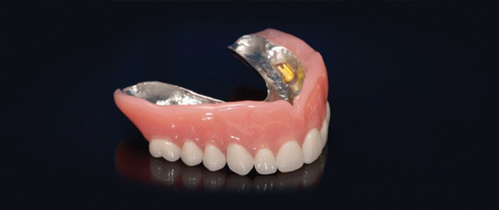 implant-denture implant teeth structure at avant dental clinic kolkata