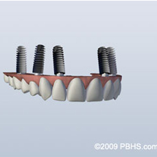 imppp implant supporter at avant dental clinic kolkata