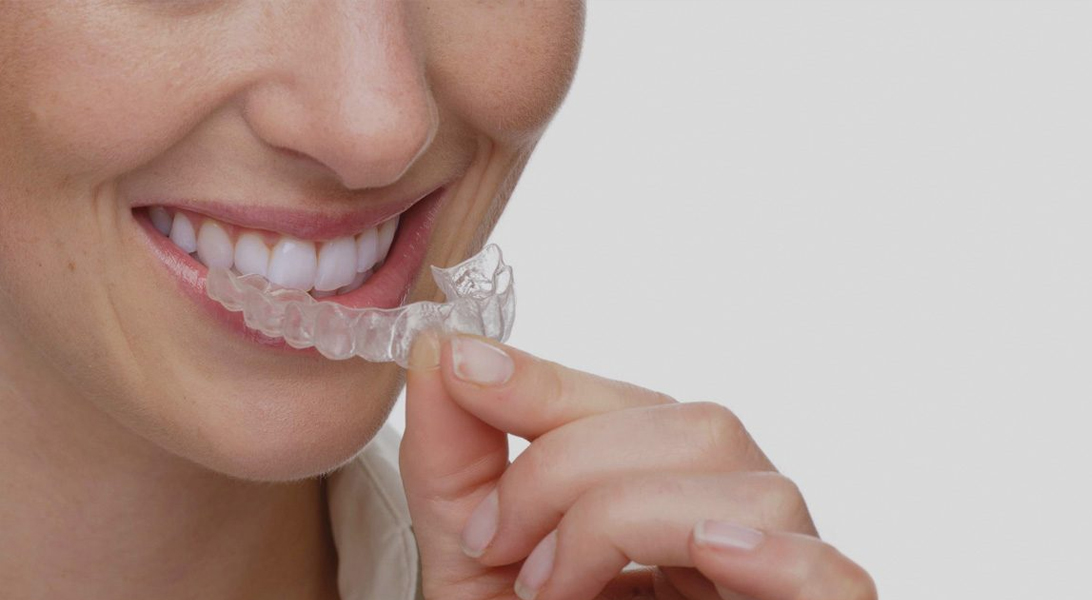 invislaign-2 invisible brace at avant dental clinic kolkata