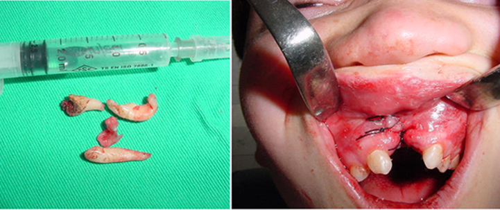 jaw-tumor2 tumor treatment at avant dental clinic kolkata