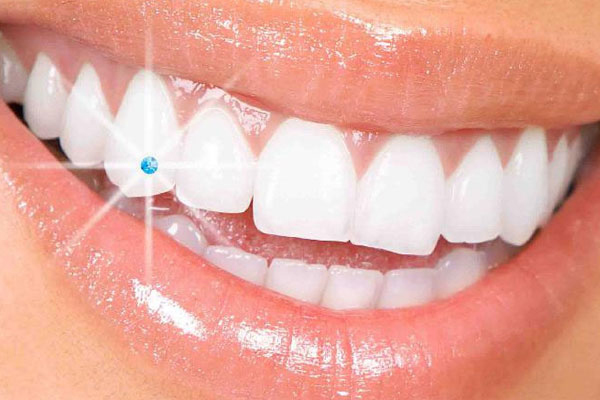 tooth jewelry implant at avant dental clinic kolkata