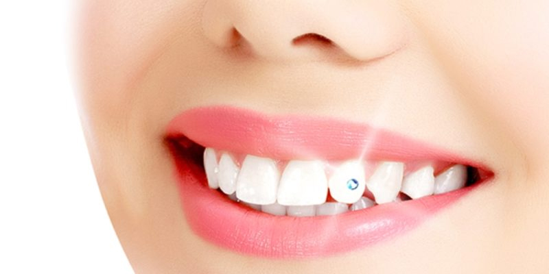 tooth jewelry at avant dental clinic kolkata