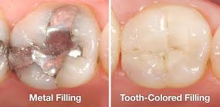 tooth filling at avant dental clinic kolkata