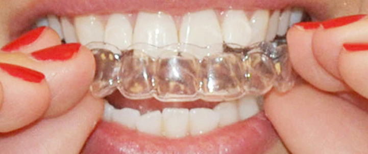 mouth-guard mouth guard at avnat dental clinic kolkata